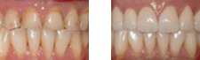 Porcelain crowns caps before and after result in Santa Barbara, CA