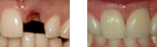 Before & after crowns, dental implants, porcelain crowns caps in Santa Barbara, CA