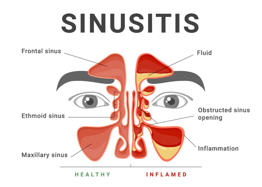 Sinusitis graphic