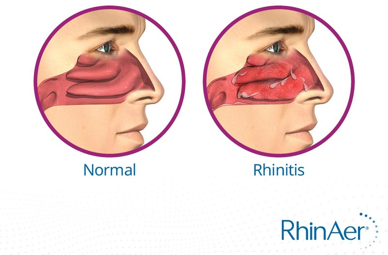 Chronic Rhinitis illustration